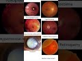 Eye examination fundoscopy findings for doctors #plab2 #eyes #opthalmology #mbbs #nurse #usmle