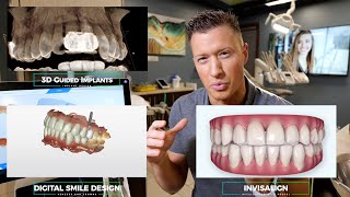 Invisalign, Implant, Full Mouth Smile Makeover with Crowns and Veneers