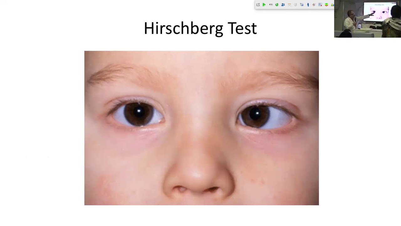 Lecture EsotropiaExotropia Dr. Carlos Solarte YouTube