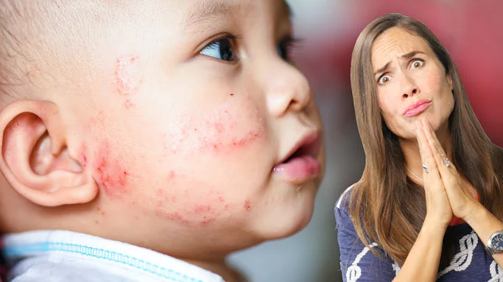 Baby Eczema: What Does it Look Like? AND How to Treat it NATURALLY! (PICTURES) - DayDayNews