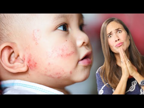 Baby Eczema: What Does it Look Like? AND How to Treat it NATURALLY! (PICTURES)