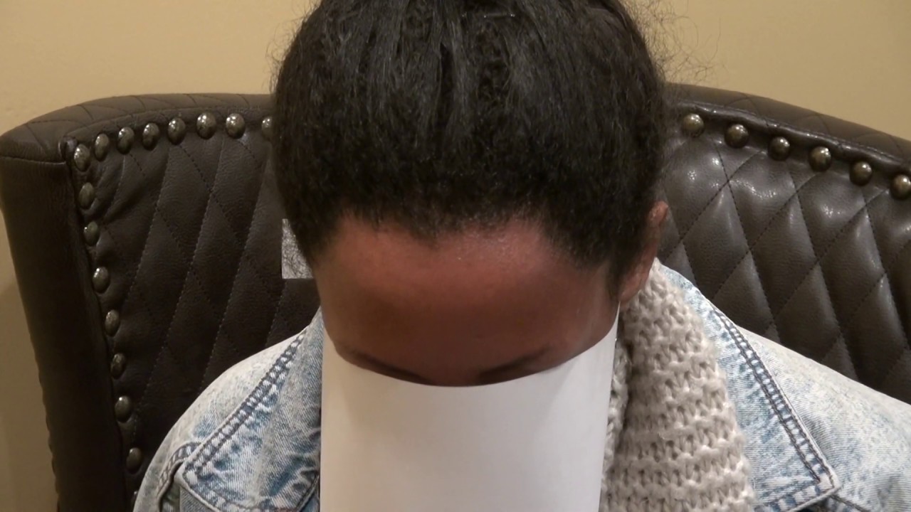 Hair Transplant Restoration On African American Patient By ...