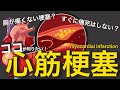 こんな症状には注意!心筋梗塞の治療と看護について 血管を広げて終わりじゃない!