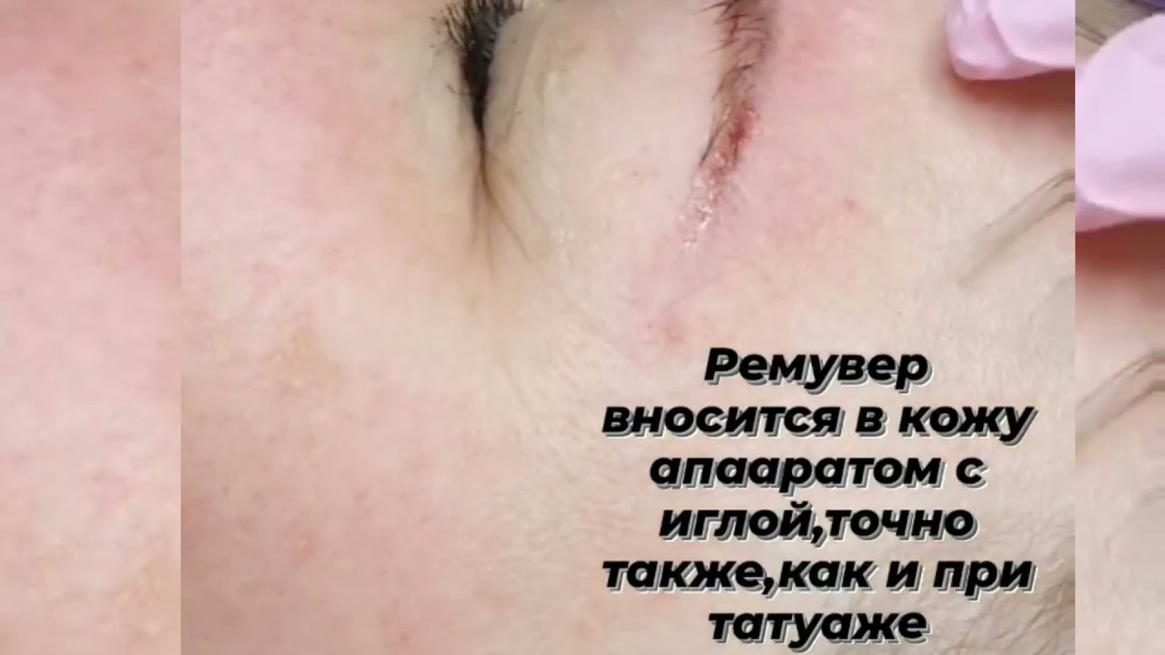 Удаление татуажа бровей ремувером мастер-тренер Осико Ольга - YouTube