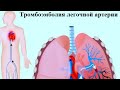 Опасное заболевание-тромбоэмболия легочной артерии.Причины и симптомы.