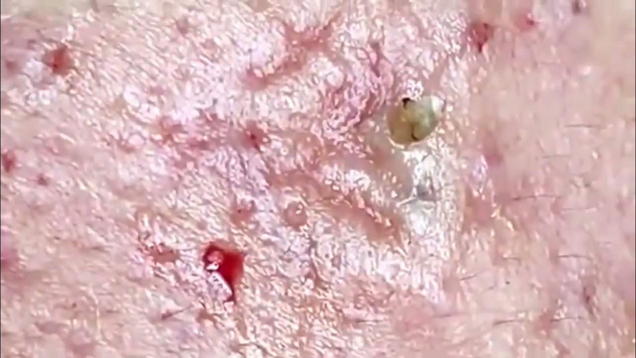 BLACKHEAD ACNE Removal for 2024 (Whiteheads, Milia, Comedones) YouTube BLACKHEAD ACNE Removal for 2024 (Whiteheads, Milia, Comedones) YouTube