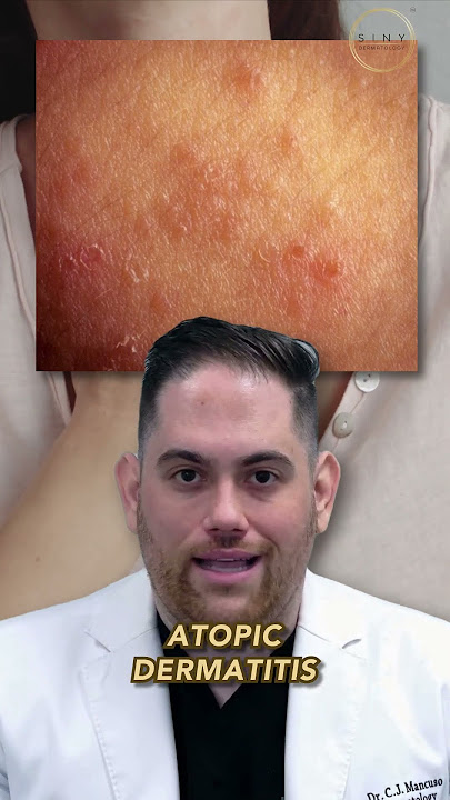 Can you tell if it's eczema or psoriasis?