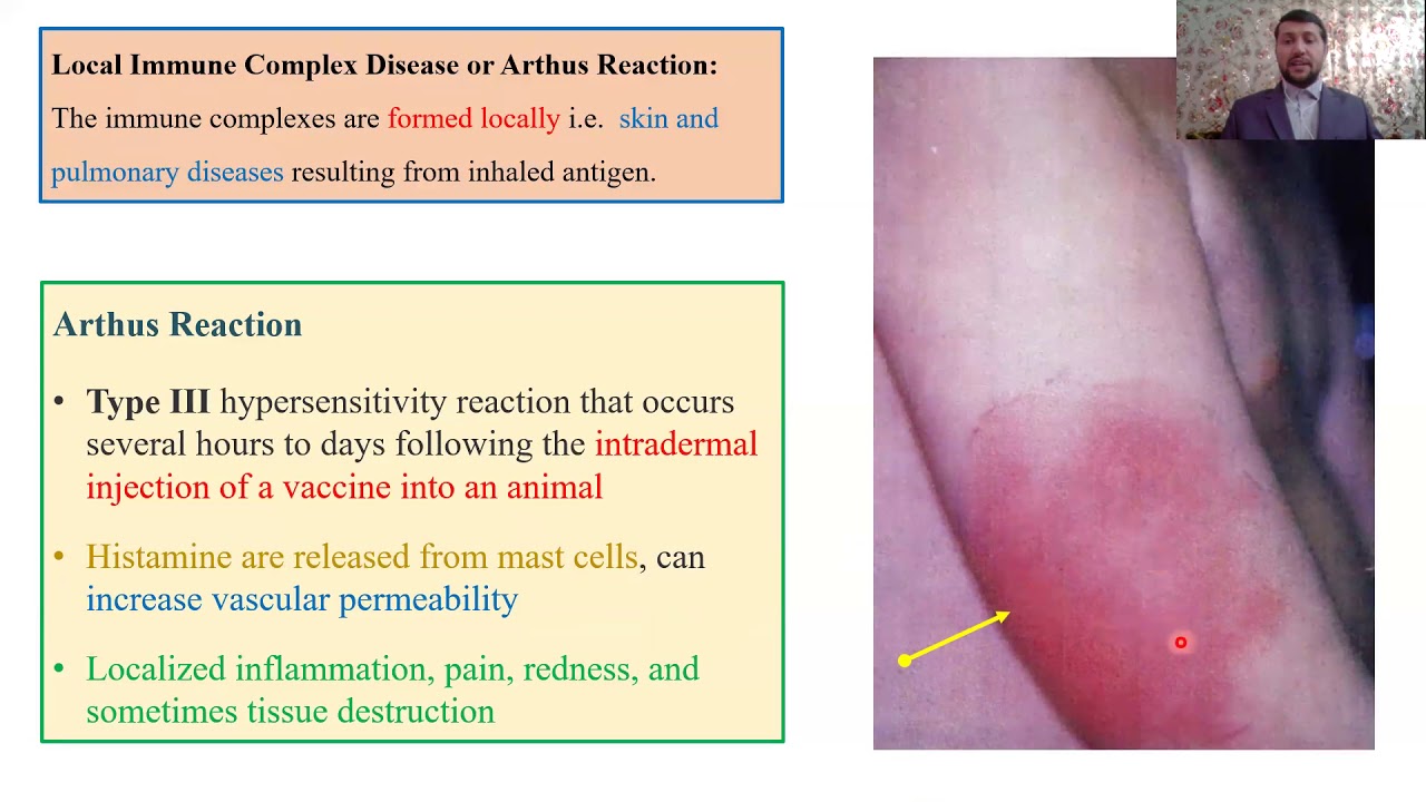 Type III – Hypersensitivity Reactions Part 3 - YouTube
