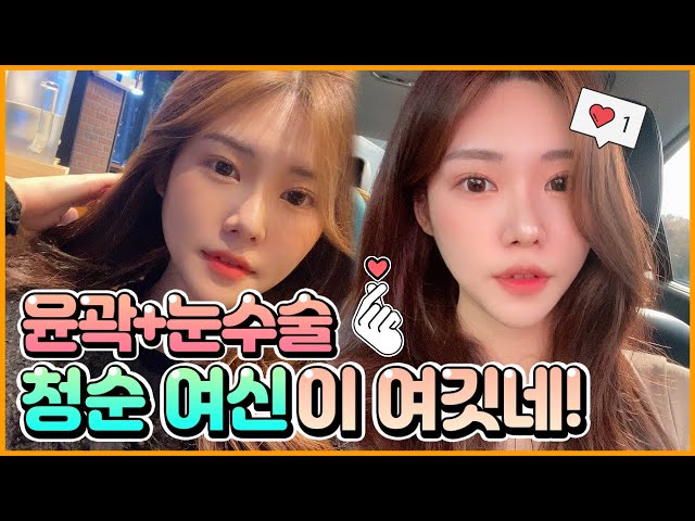 윤곽수술 눈매교정│ 쎈캐에서 수술 후 세상 청순🌸 분위기 장착한 썰❤