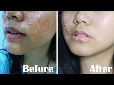 Cara Menghilangkan Bekas Jerawat N Memutihkan Wajah  