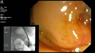 ERCP ; Huge tortuous bile duct dilatation without obvious stricture seen.