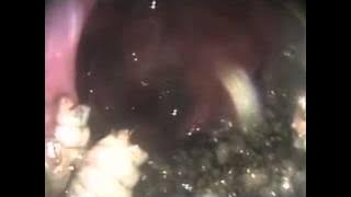 Nasal Myiasis | NEJM