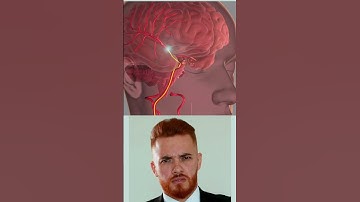 Brain Stroke |Mechanical Thrombectomy stroke  animation video #brainstroke