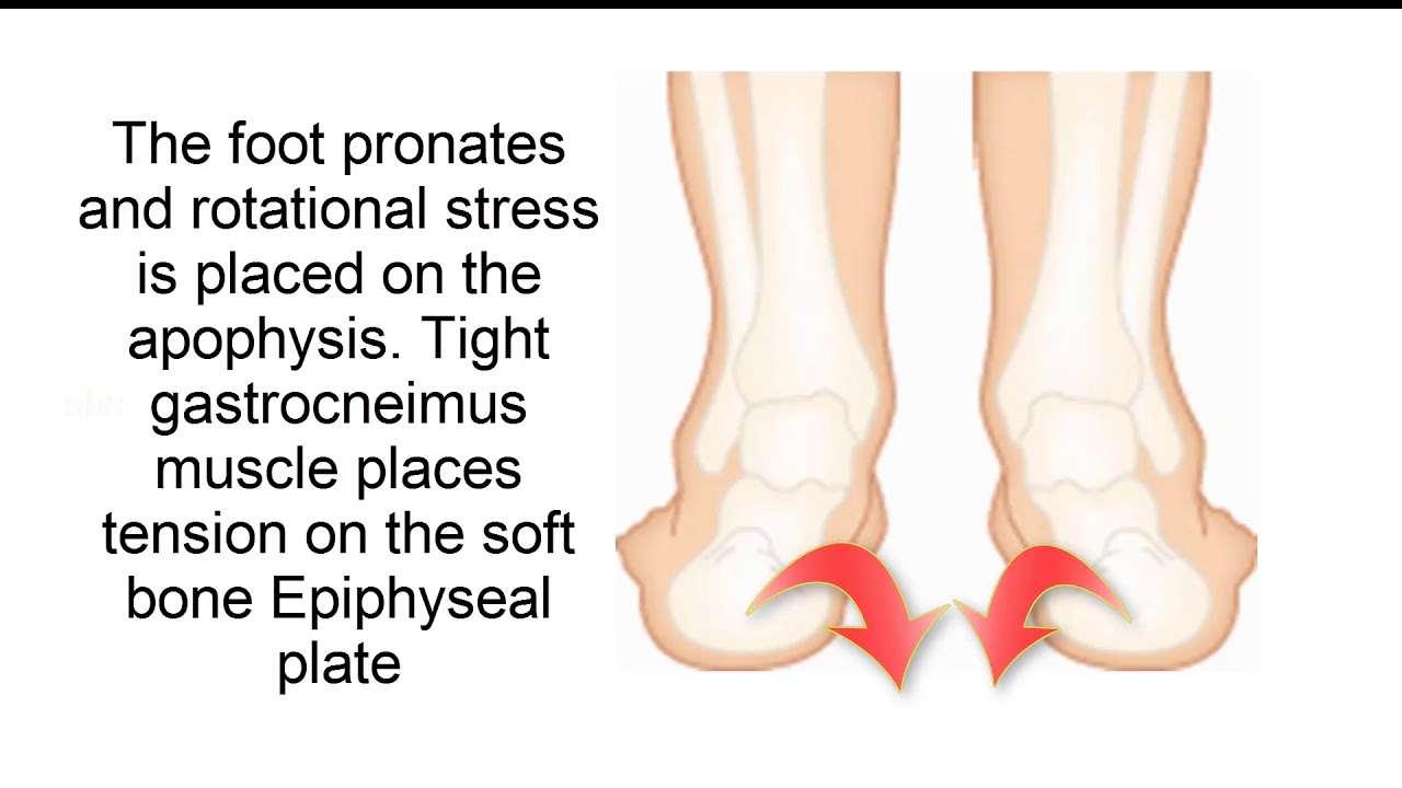 Sever's Disease | Heel Pain Treatment | Melbourne Podiatrists