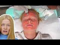 I TRY VAMPIRE FACIAL FOR FIRST TIME *prp microneedling*