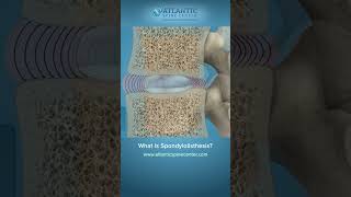 Back Pain from Spondylolisthesis?