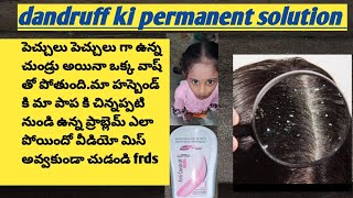 dandruff,dandruff treatment,dandruff removal,dandruff treatment at home,how to get rid of dandruff,