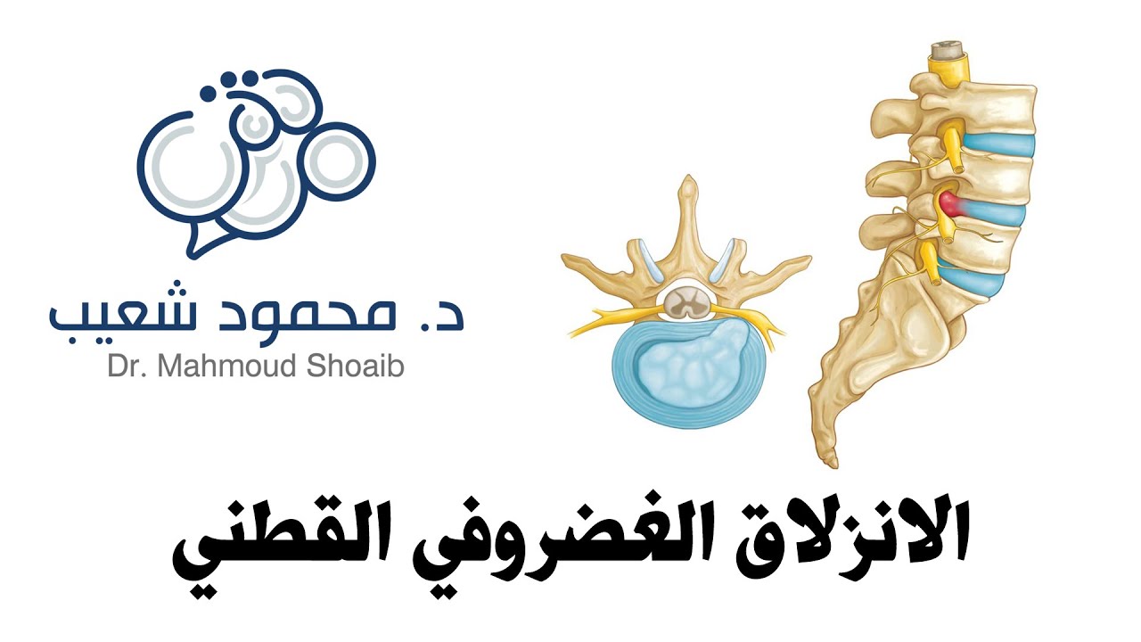الانزلاق الغضروفي القطني - د. محمود شعيب