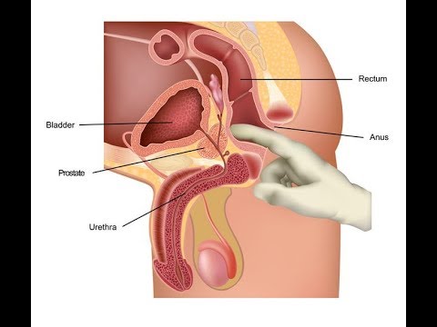 cipro non funziona per la prostatite
