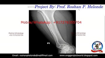 Bone Fracture Detection Using Python Opencv | Bone Fracture Prediction Using Image Processing