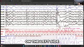 EEG Montage Explained: Understanding Sleep Electrode Placement #shorts