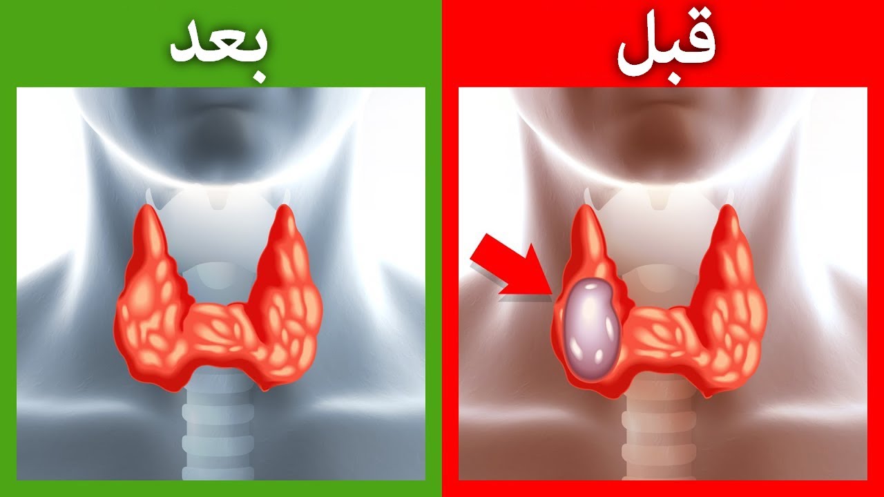 كيفية التخلص من أورام الغدة الدرقية بشكل طبيعي | العقد الدرقية