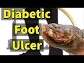 Diabetic Foot Ulcer: Removing the Dead Tissue with Sharp Debridement