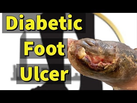diabetic-foot-ulcer:-removing-the-dead-tissue-with-sharp-debridement