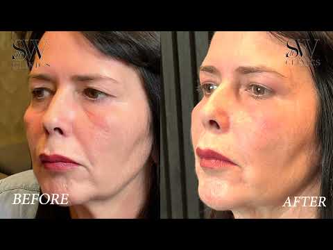 Gina's DRSW Non-Surgical Blepharoplasty Review