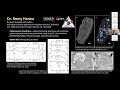 Carbonaceous Chondrites — Nebular/Accretion Processes and Secondary Processing