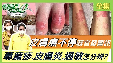 過敏起疹子 惱人皮膚癢 慢性皮膚炎 是器官生病了？！ 健康2.0 20210829 (完整版) - 天天要聞