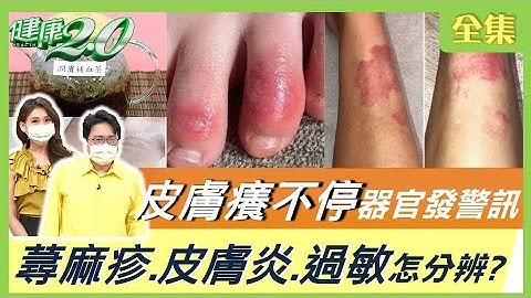過敏起疹子 惱人皮膚癢 慢性皮膚炎 是器官生病了？！ 健康2.0 20210829 (完整版) - 天天要聞