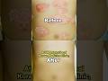 The Korean Secret to Curing Psoriasis #shorts