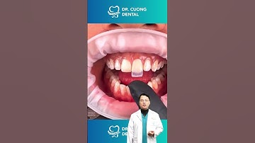 Răng sứ siêu mỏng |Dr Cường Official