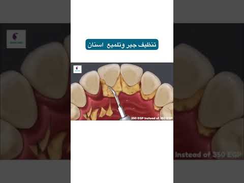خطوات تنظيف الجير بجهاز الالتراسو ببساطه بدون الم