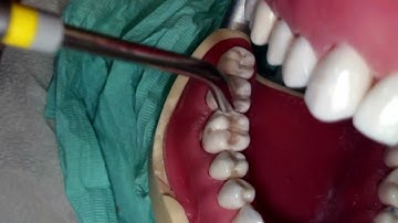 Class II Composite Finishing and Polishing