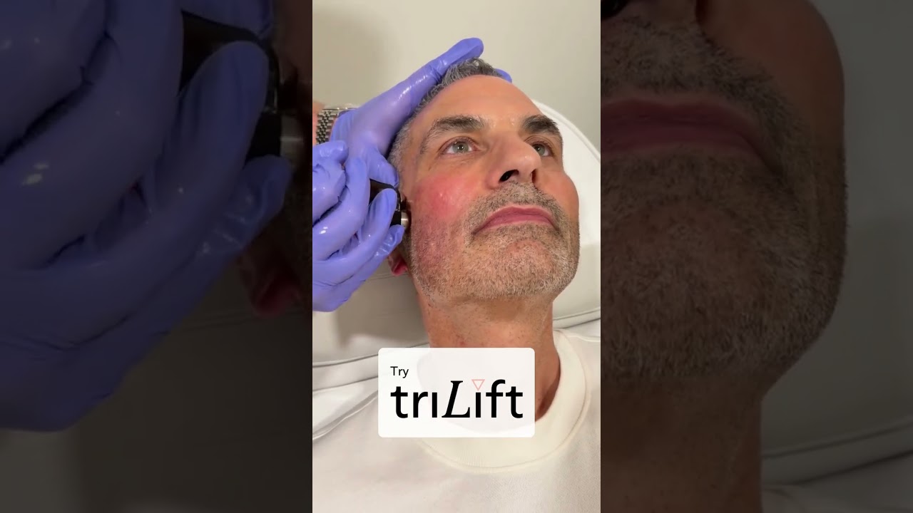 Have you tried triLift by Lumenis?