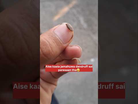 Treat oily dandruff