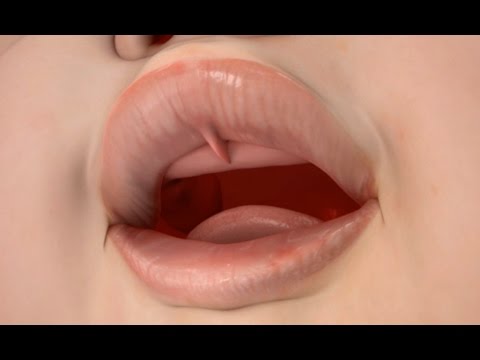 Video: Lip Tie In Neonati E Bambini Piccoli: Sintomi E Trattamento