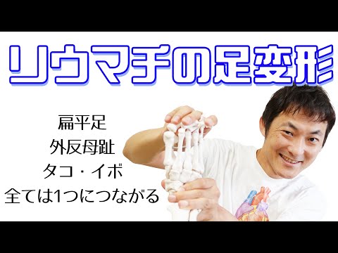 リウマチの足変形～扁平足・外反母趾・槌指・胼胝・鶏眼は1つのストーリー～：足関節(Part.9)