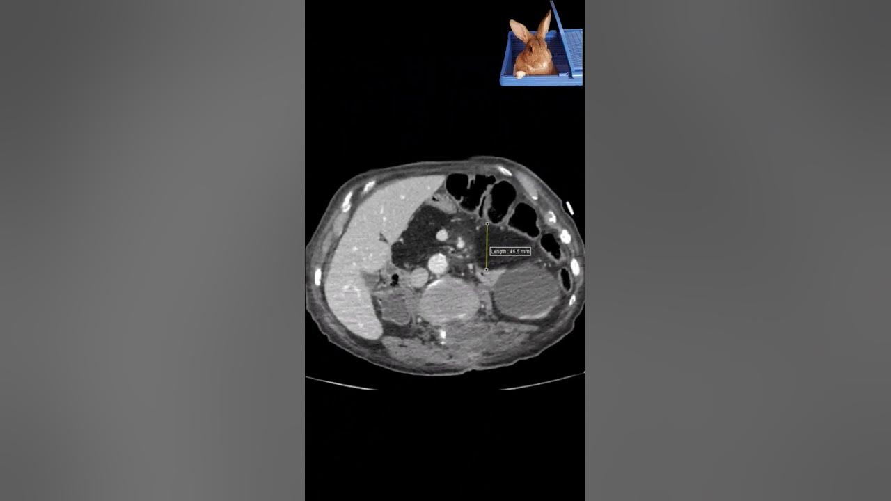 pancreatic-lypomatosis-95-years-old-male-patient-radiology-mri-xray