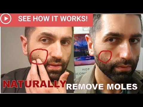 How To NATURALLY Remove Moles (This Works!)