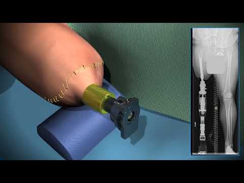 Dr. Rozbruch explains Osseointegration Limb Replacement Surgery with an animation