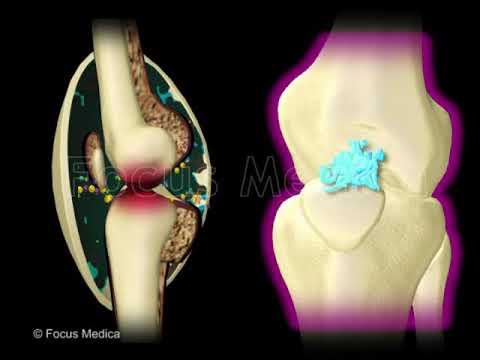 What Osteoarthritis 2017