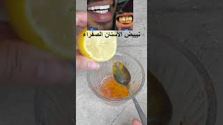 تبييض الأسنان الصفراء نتيجة وااااووووو