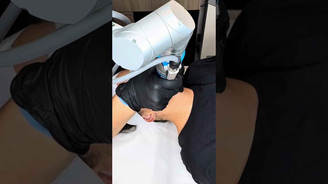 Laser Carbon Facial -Hollywood Facial CLC 