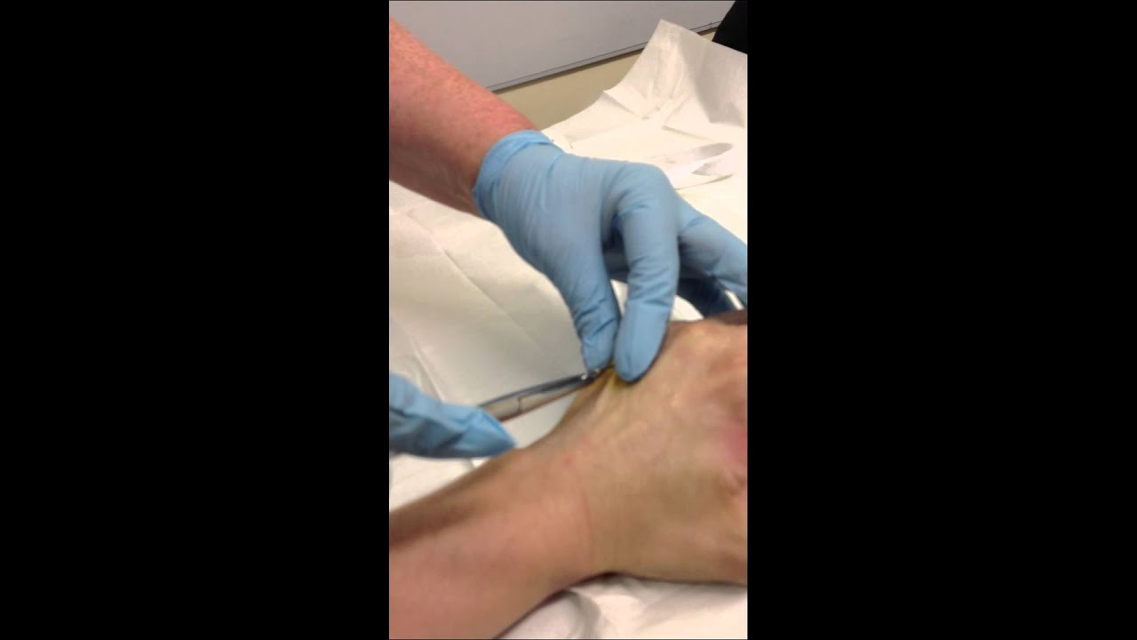 Pin being removed from little finger (pinky) YouTube