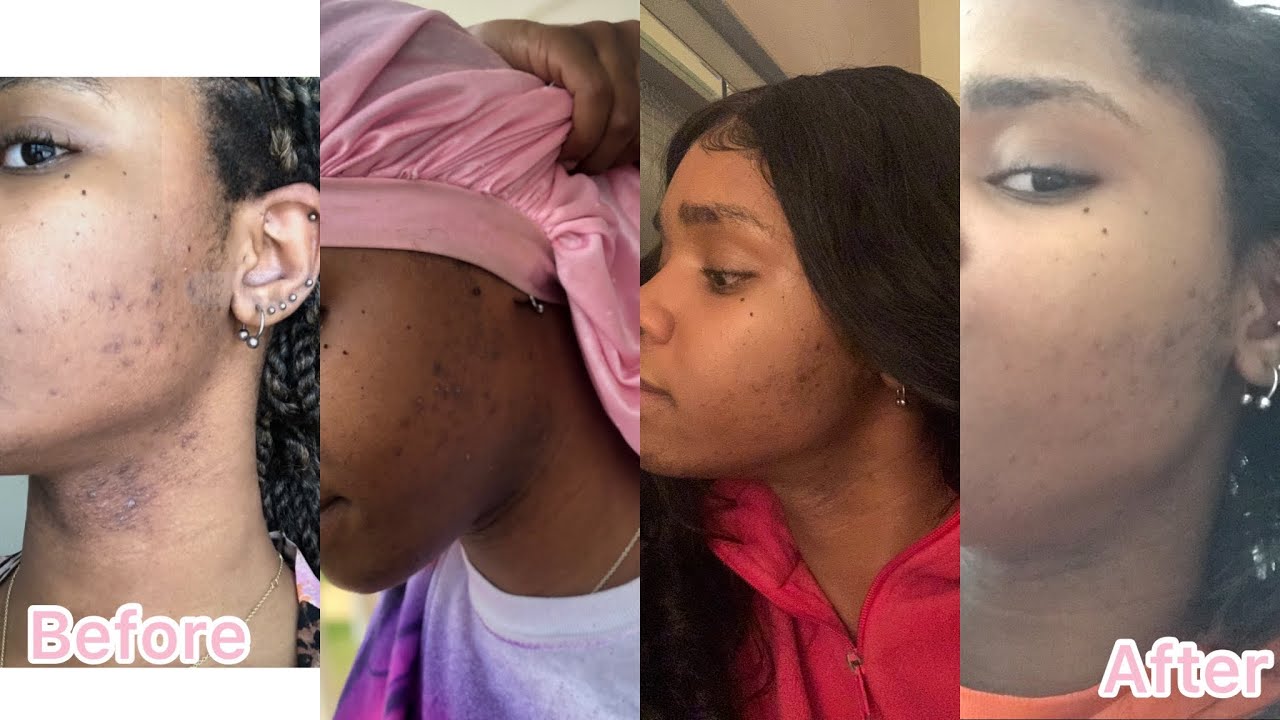 ASMR Skin Care Routine To Manage PCOS Type Skin (dark spots & hyperpigmentation)