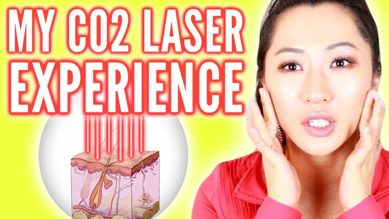 CO2 Laser for Acne Scars! Was it Worth it? YouTube