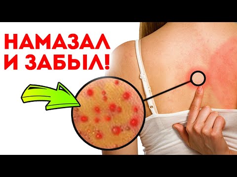 Домашние убийцы дерматита! Народные мази + советы ученых от дерматита